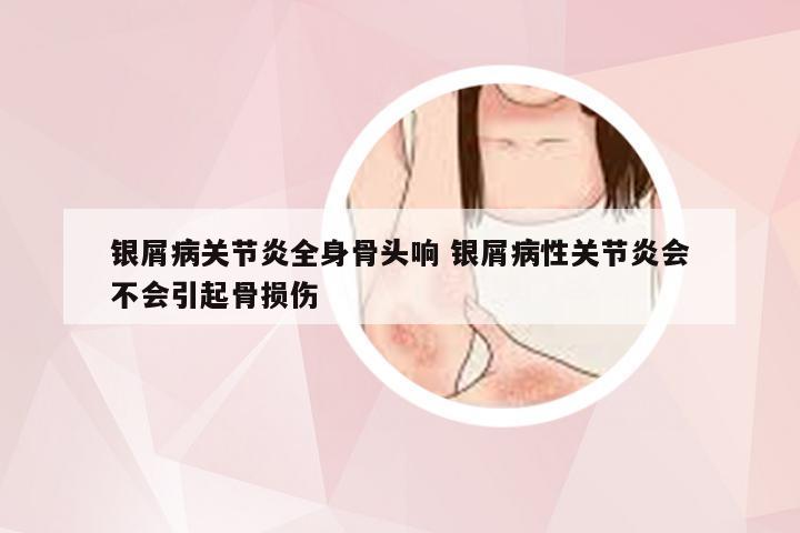 银屑病关节炎全身骨头响 银屑病性关节炎会不会引起骨损伤
