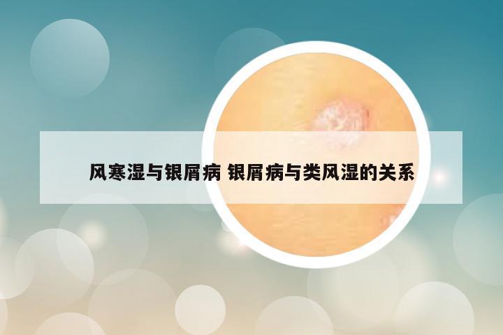 风寒湿与银屑病 银屑病与类风湿的关系
