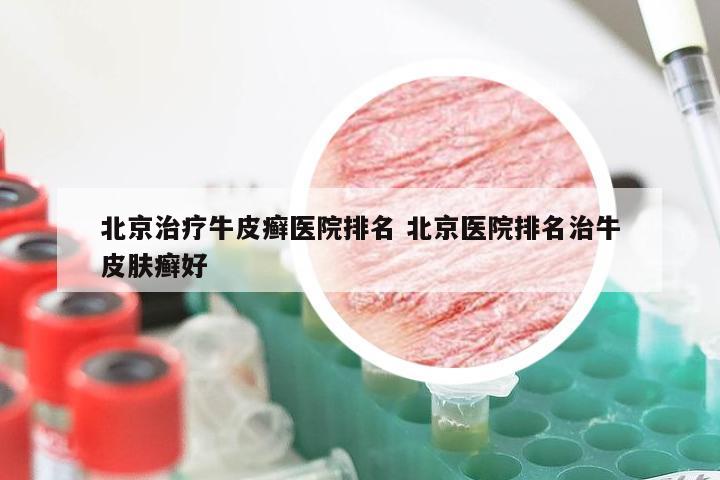 北京治疗牛皮癣医院排名 北京医院排名治牛皮肤癣好