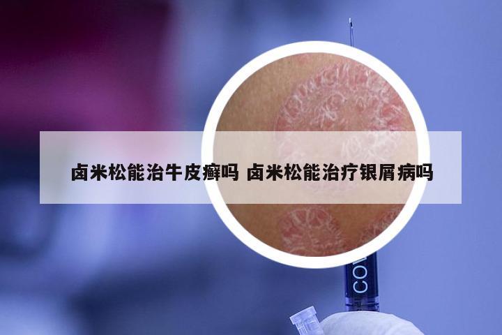 卤米松能治牛皮癣吗 卤米松能治疗银屑病吗