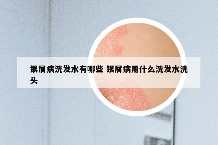 银屑病洗发水有哪些 银屑病用什么洗发水洗头