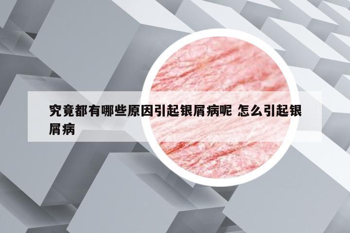 究竟都有哪些原因引起银屑病呢 怎么引起银屑病