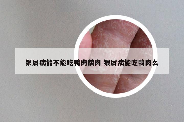 银屑病能不能吃鸭肉鹅肉 银屑病能吃鸭肉么
