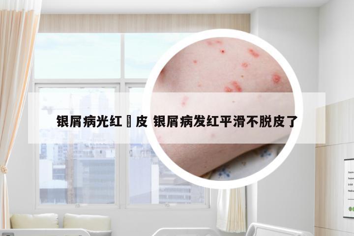 银屑病光红沒皮 银屑病发红平滑不脱皮了