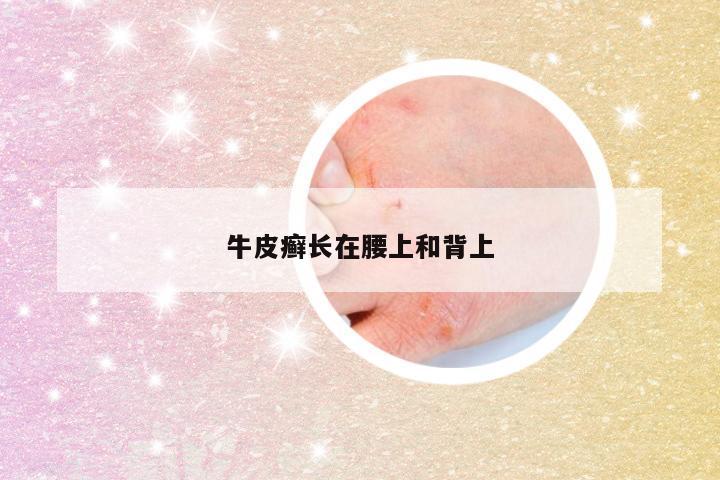牛皮癣长在腰上和背上