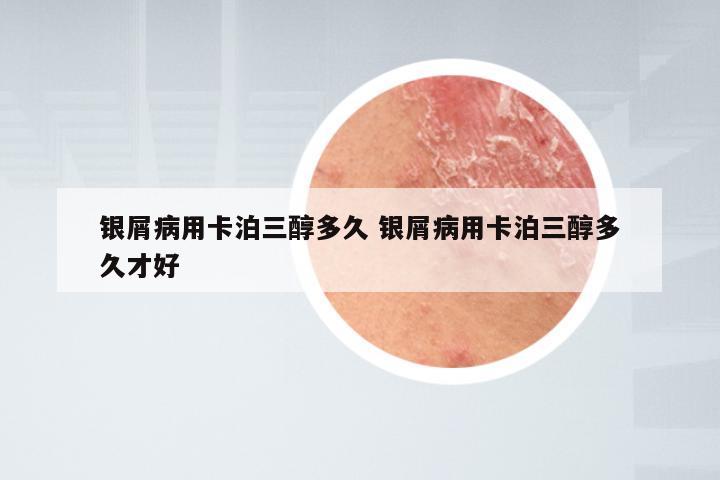 银屑病用卡泊三醇多久 银屑病用卡泊三醇多久才好
