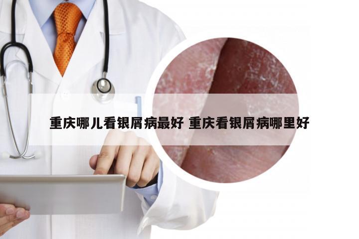 重庆哪儿看银屑病最好 重庆看银屑病哪里好