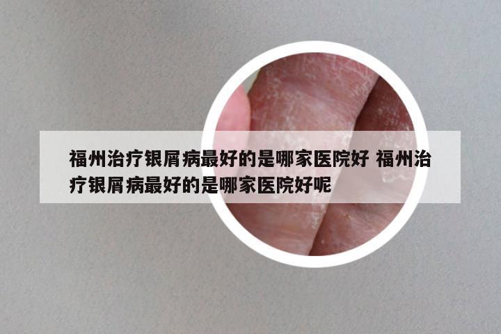 福州治疗银屑病最好的是哪家医院好 福州治疗银屑病最好的是哪家医院好呢