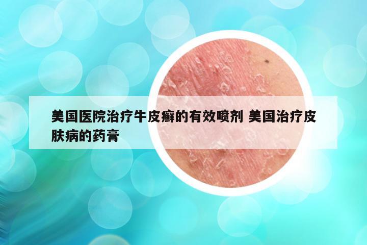 美国医院治疗牛皮癣的有效喷剂 美国治疗皮肤病的药膏