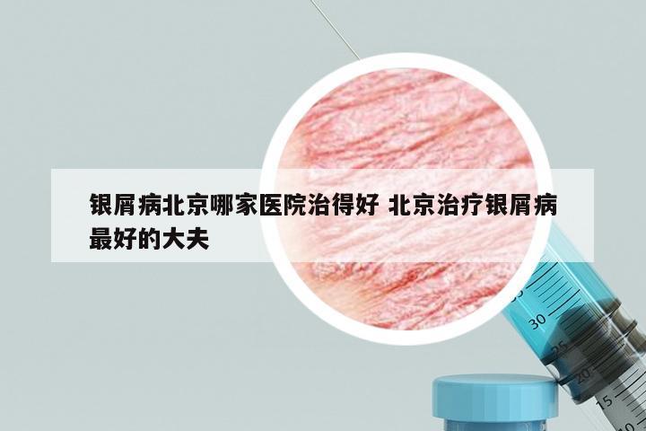 银屑病北京哪家医院治得好 北京治疗银屑病最好的大夫