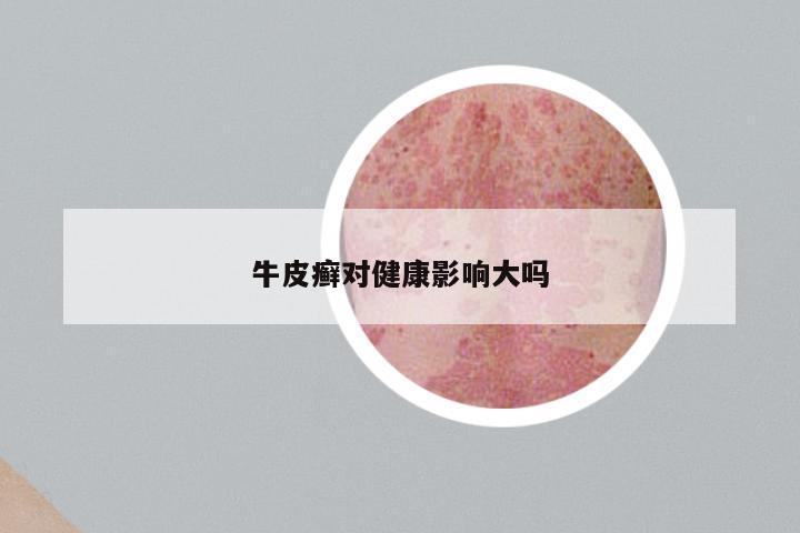 牛皮癣对健康影响大吗
