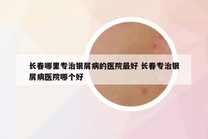 长春哪里专治银屑病的医院最好 长春专治银屑病医院哪个好