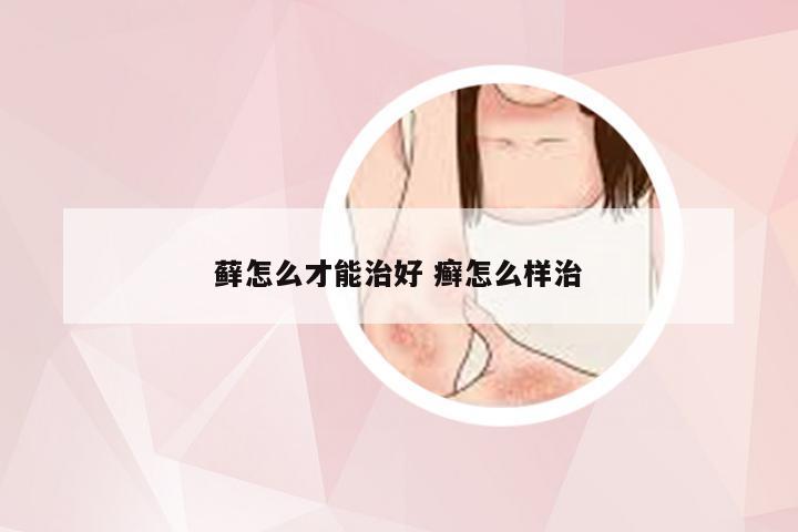 藓怎么才能治好 癣怎么样治