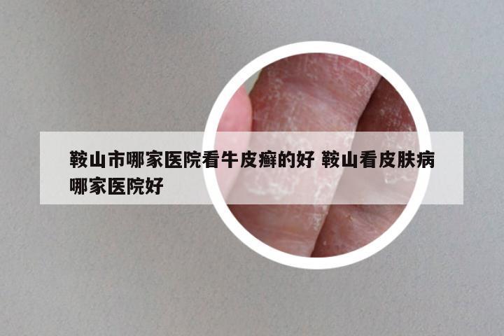 鞍山市哪家医院看牛皮癣的好 鞍山看皮肤病哪家医院好