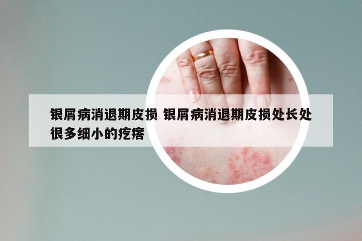 银屑病消退期皮损 银屑病消退期皮损处长处很多细小的疙瘩