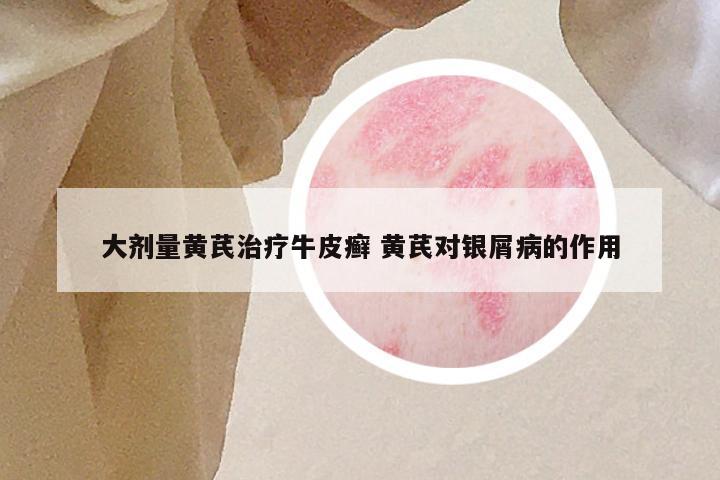 大剂量黄芪治疗牛皮癣 黄芪对银屑病的作用