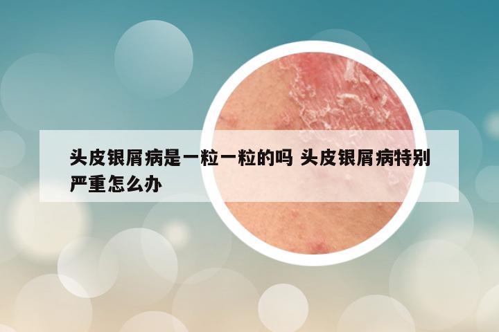 头皮银屑病是一粒一粒的吗 头皮银屑病特别严重怎么办