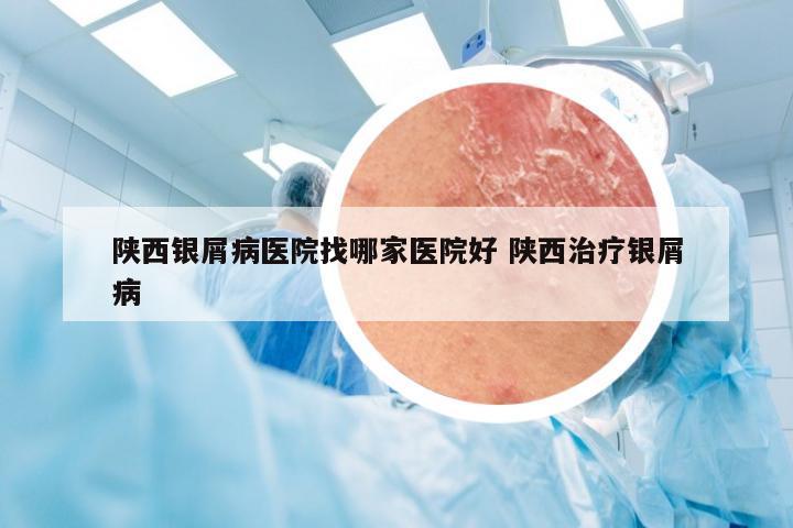 陕西银屑病医院找哪家医院好 陕西治疗银屑病
