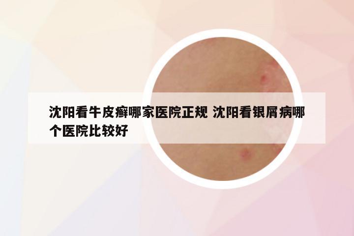 沈阳看牛皮癣哪家医院正规 沈阳看银屑病哪个医院比较好