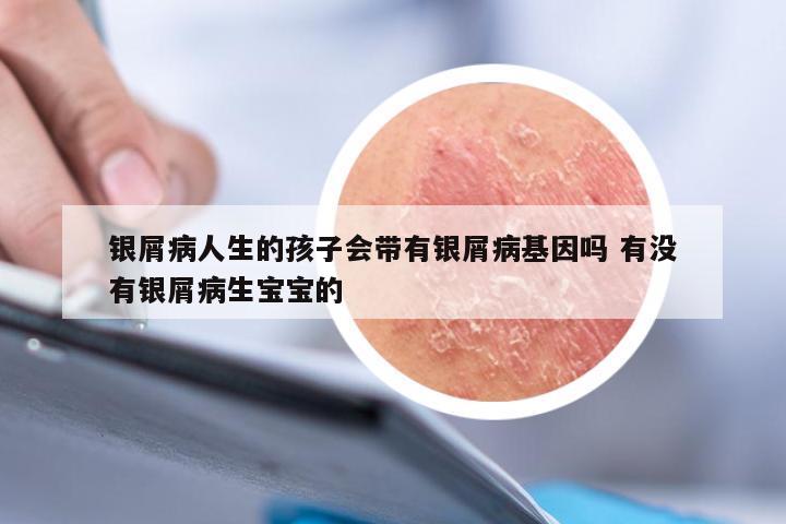 银屑病人生的孩子会带有银屑病基因吗 有没有银屑病生宝宝的