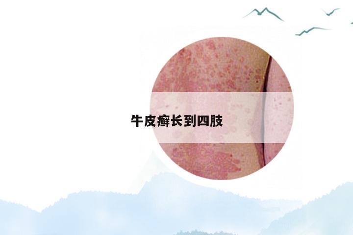 牛皮癣长到四肢
