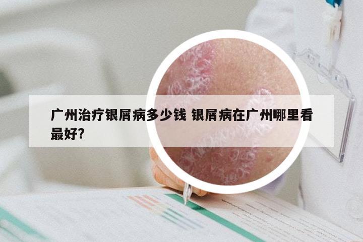 广州治疗银屑病多少钱 银屑病在广州哪里看最好?