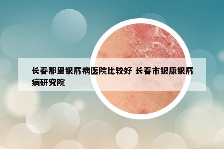 长春那里银屑病医院比较好 长春市银康银屑病研究院