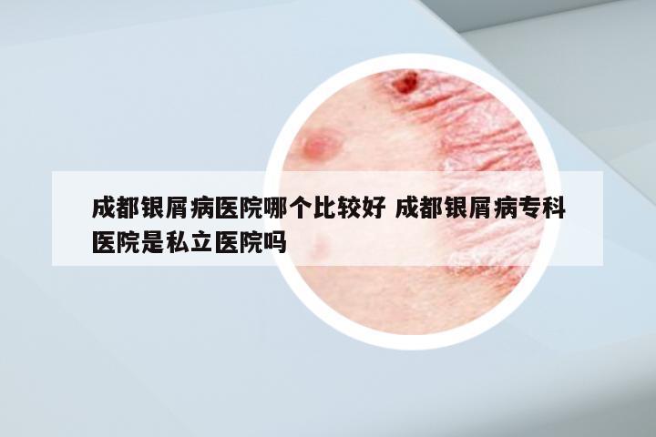 成都银屑病医院哪个比较好 成都银屑病专科医院是私立医院吗