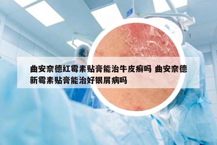 曲安奈德红霉素贴膏能治牛皮癣吗 曲安奈德新霉素贴膏能治好银屑病吗