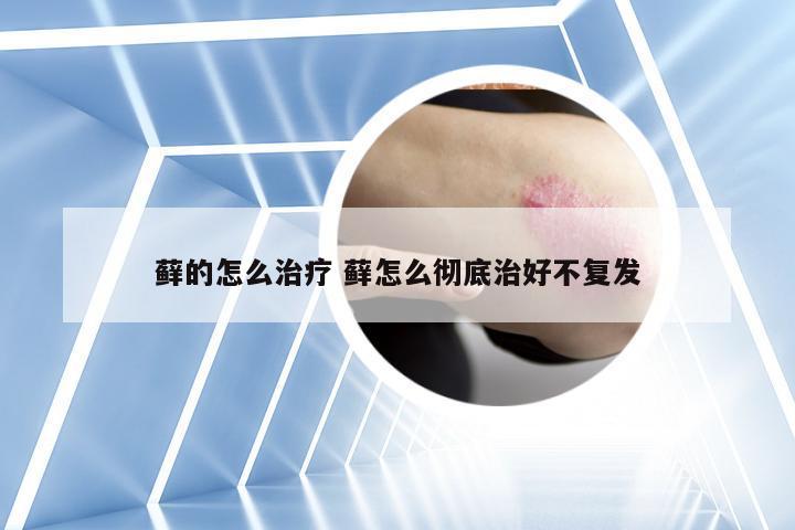 藓的怎么治疗 藓怎么彻底治好不复发