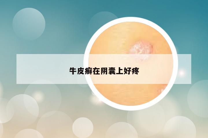 牛皮癣在阴囊上好疼