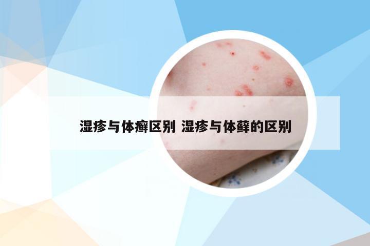湿疹与体癣区别 湿疹与体藓的区别