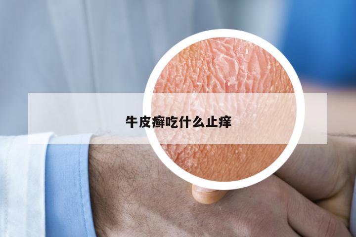 牛皮癣吃什么止痒