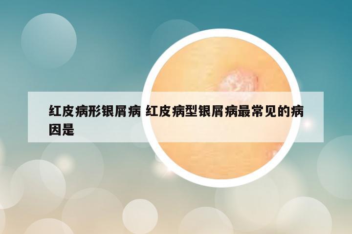 红皮病形银屑病 红皮病型银屑病最常见的病因是