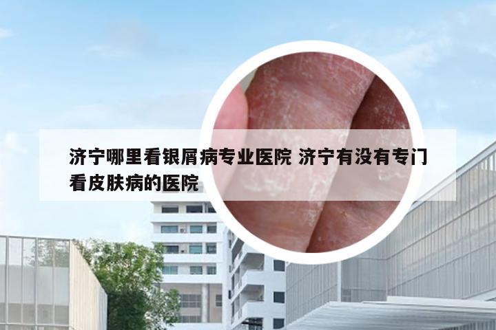 济宁哪里看银屑病专业医院 济宁有没有专门看皮肤病的医院