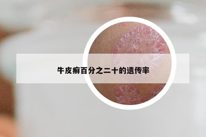 牛皮癣百分之二十的遗传率