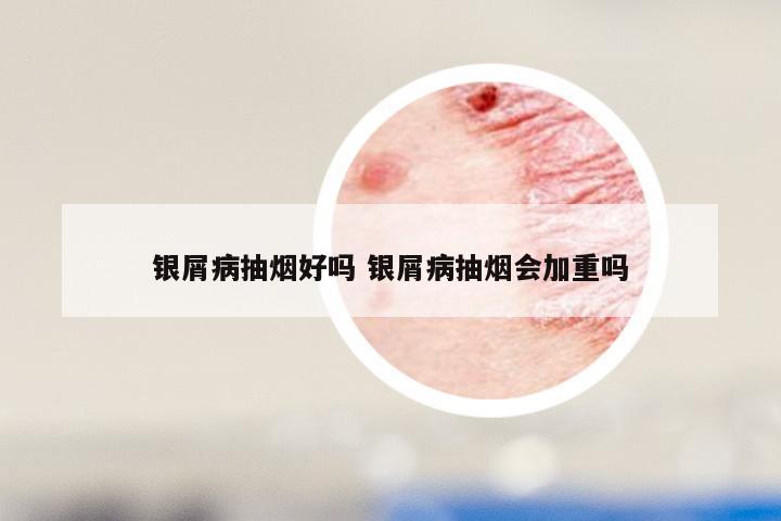 银屑病抽烟好吗 银屑病抽烟会加重吗