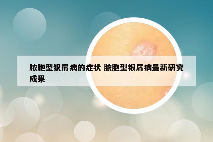 脓胞型银屑病的症状 脓胞型银屑病最新研究成果