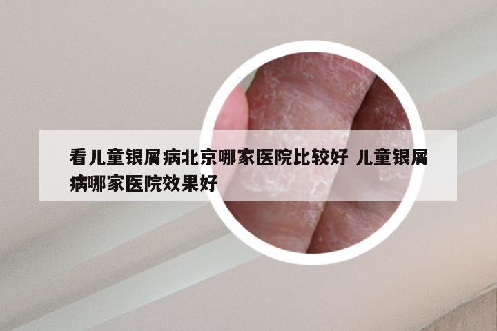 看儿童银屑病北京哪家医院比较好 儿童银屑病哪家医院效果好