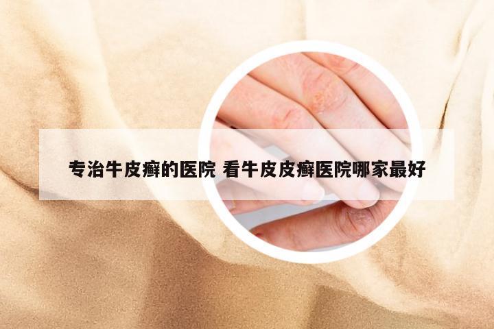 专治牛皮癣的医院 看牛皮皮癣医院哪家最好