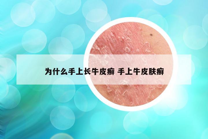 为什么手上长牛皮癣 手上牛皮肤癣