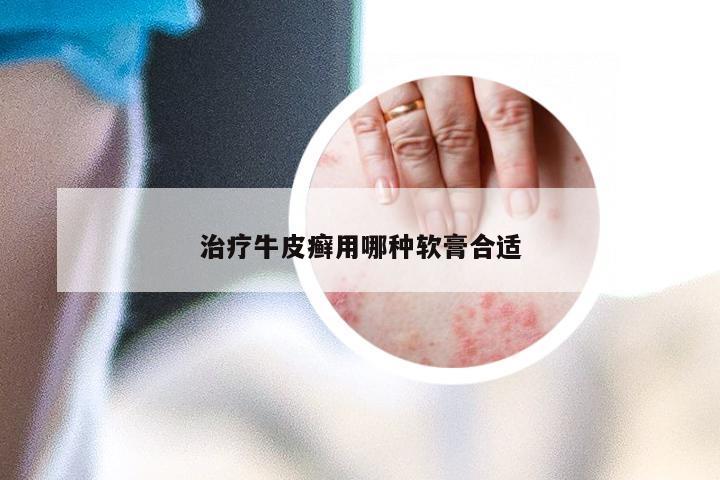 治疗牛皮癣用哪种软膏合适
