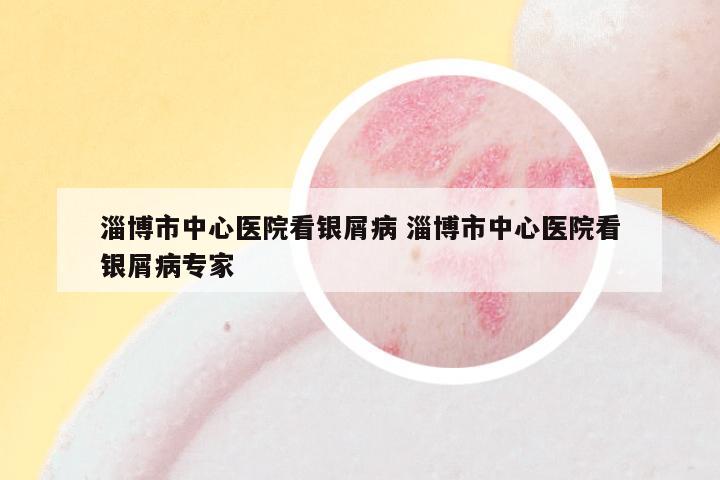 淄博市中心医院看银屑病 淄博市中心医院看银屑病专家