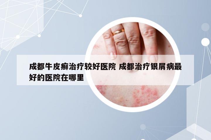 成都牛皮癣治疗较好医院 成都治疗银屑病最好的医院在哪里
