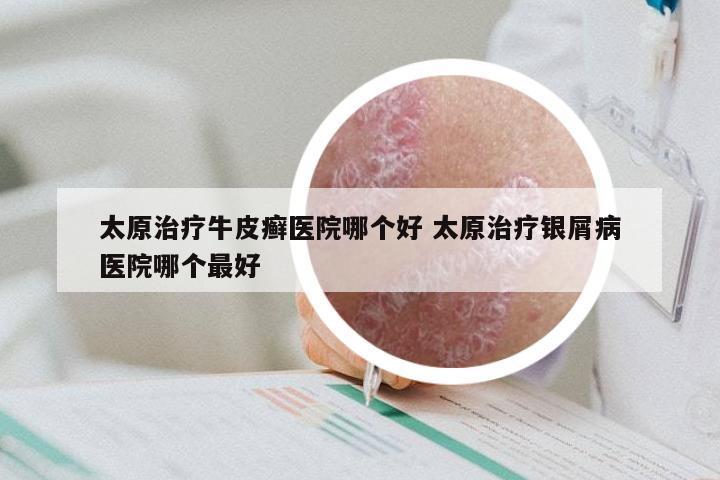 太原治疗牛皮癣医院哪个好 太原治疗银屑病医院哪个最好