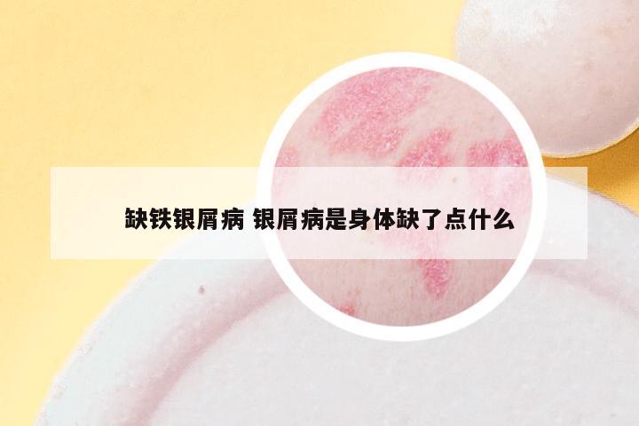 缺铁银屑病 银屑病是身体缺了点什么