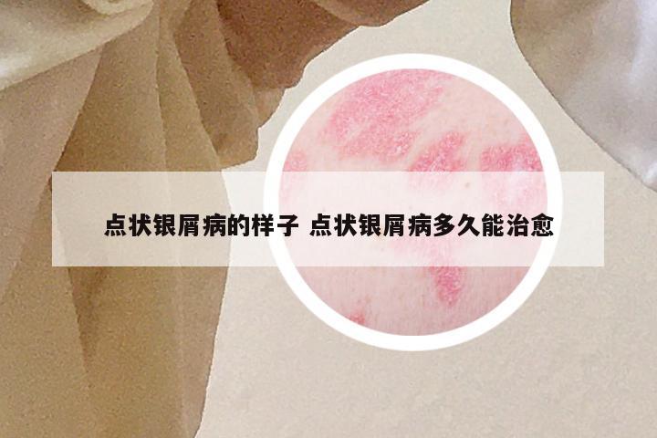 点状银屑病的样子 点状银屑病多久能治愈