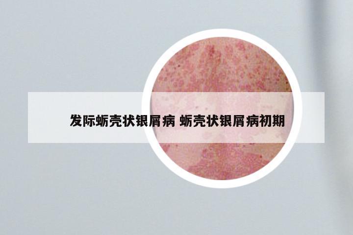 发际蛎壳状银屑病 蛎壳状银屑病初期