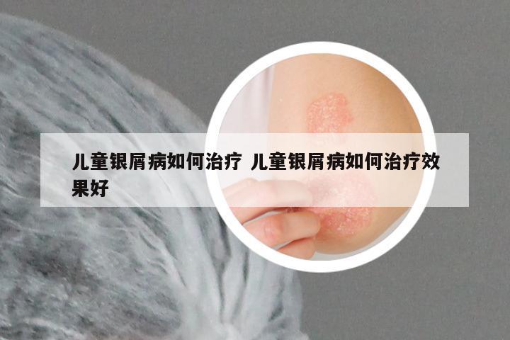 儿童银屑病如何治疗 儿童银屑病如何治疗效果好