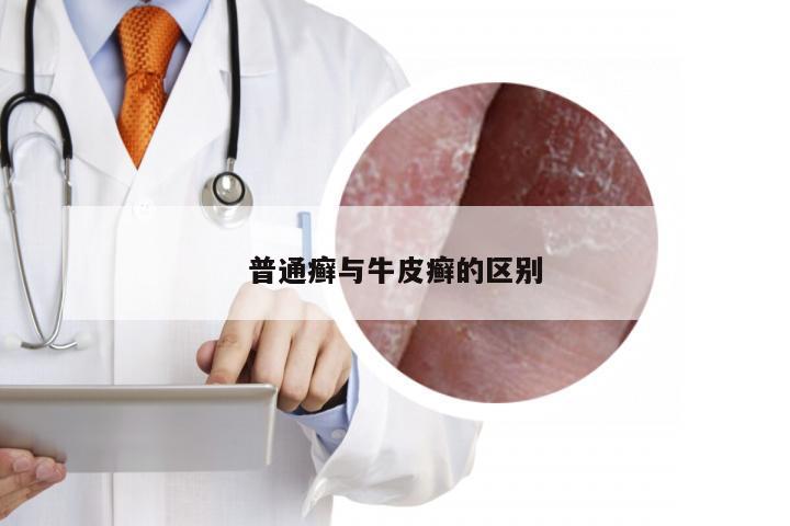 普通癣与牛皮癣的区别
